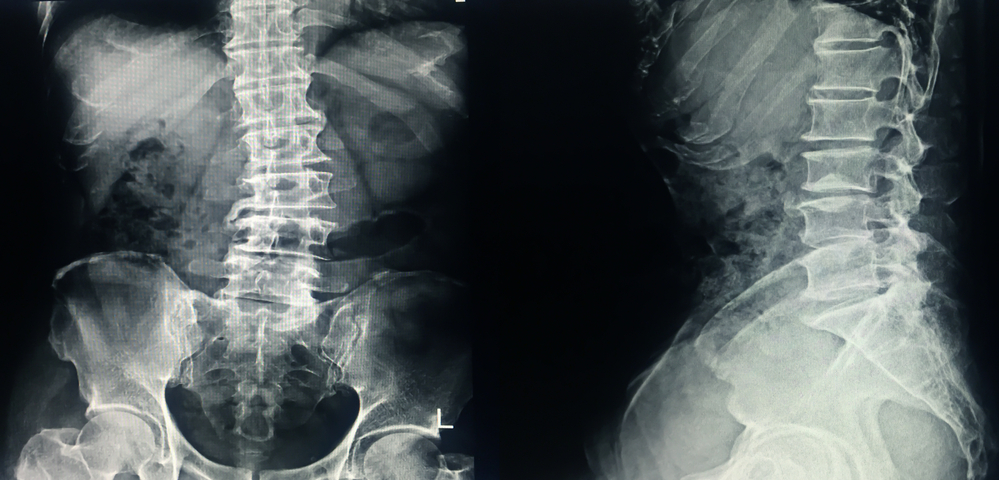 Can Scoliosis Get Worse With Age?